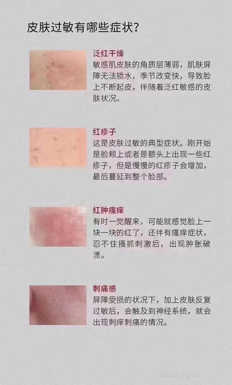 皮肤过敏症状有哪几种呢