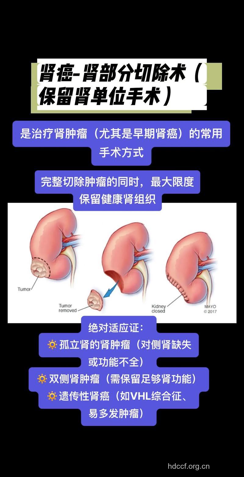 手术治疗肾癌有哪些原则