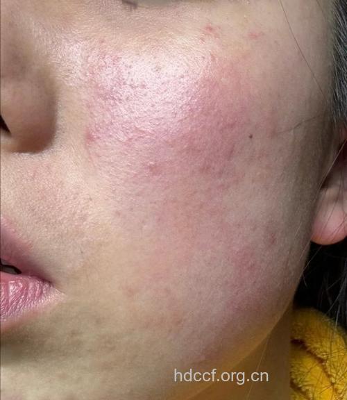 皮肤过敏会有什么症状