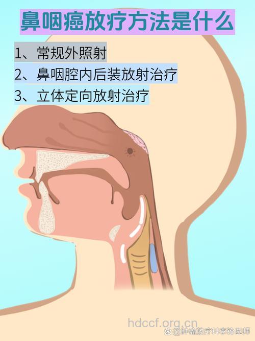 晚期鼻咽癌有哪些治疗法