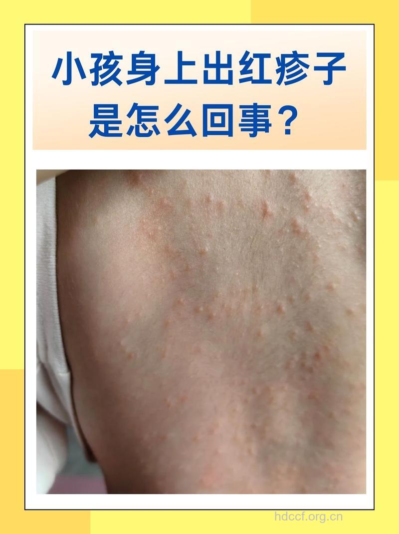 小儿皮肤过敏疾病有什么症状