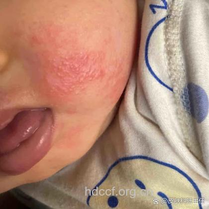 婴儿脸部皮肤过敏有什么症状