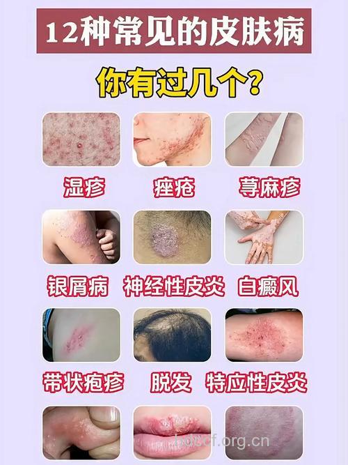常见的皮肤病有哪些症状