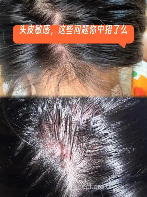 测试,你的头皮过敏了吗?