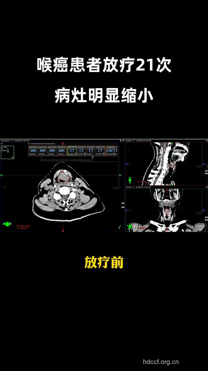 肿瘤手术前后有哪些放疗方法