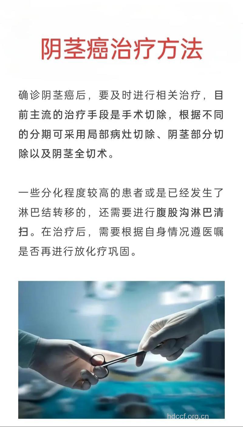 怎么治疗阴茎肿瘤方法