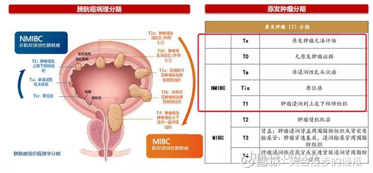怎么分型治疗膀胱癌方法