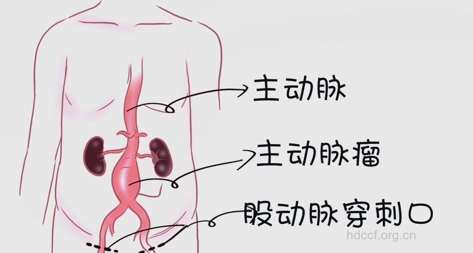 怎么认识腹主动脉瘤
