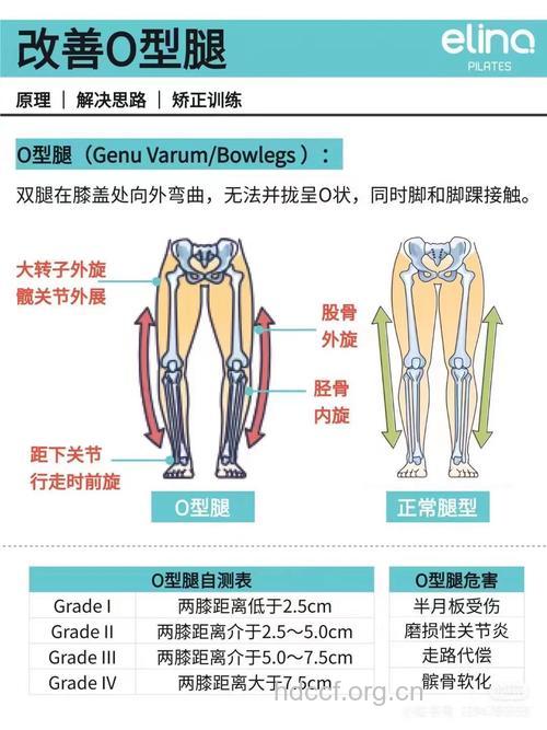 O型腿的影响及矫正办法