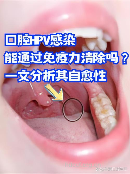 口腔癌怎么治疗