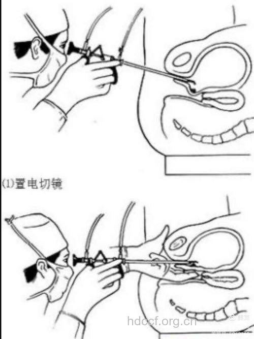膀胱肿瘤经尿道电切术后的护理
