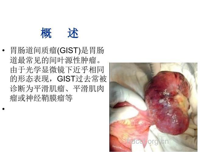 多层螺旋CT对胃肠道间质瘤有何诊断价值