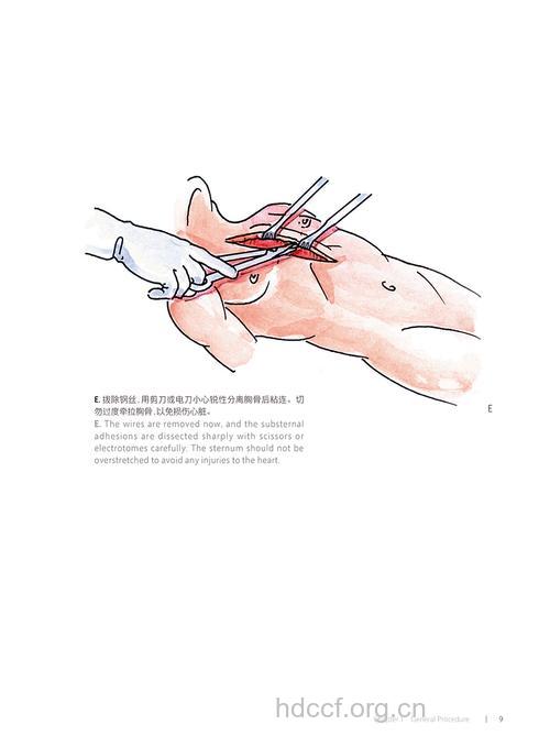 怎么进行心脏手术方法