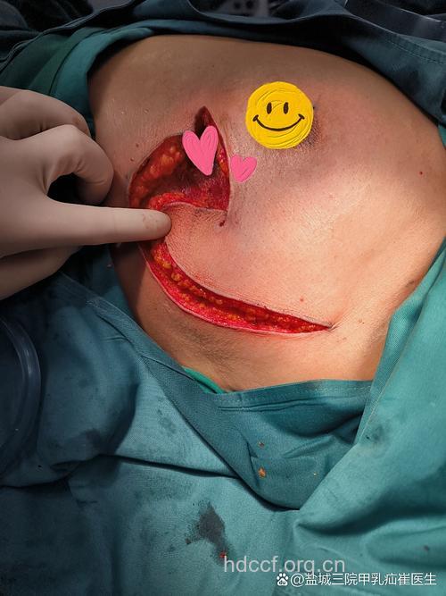 得了乳腺癌可以做保乳手术吗