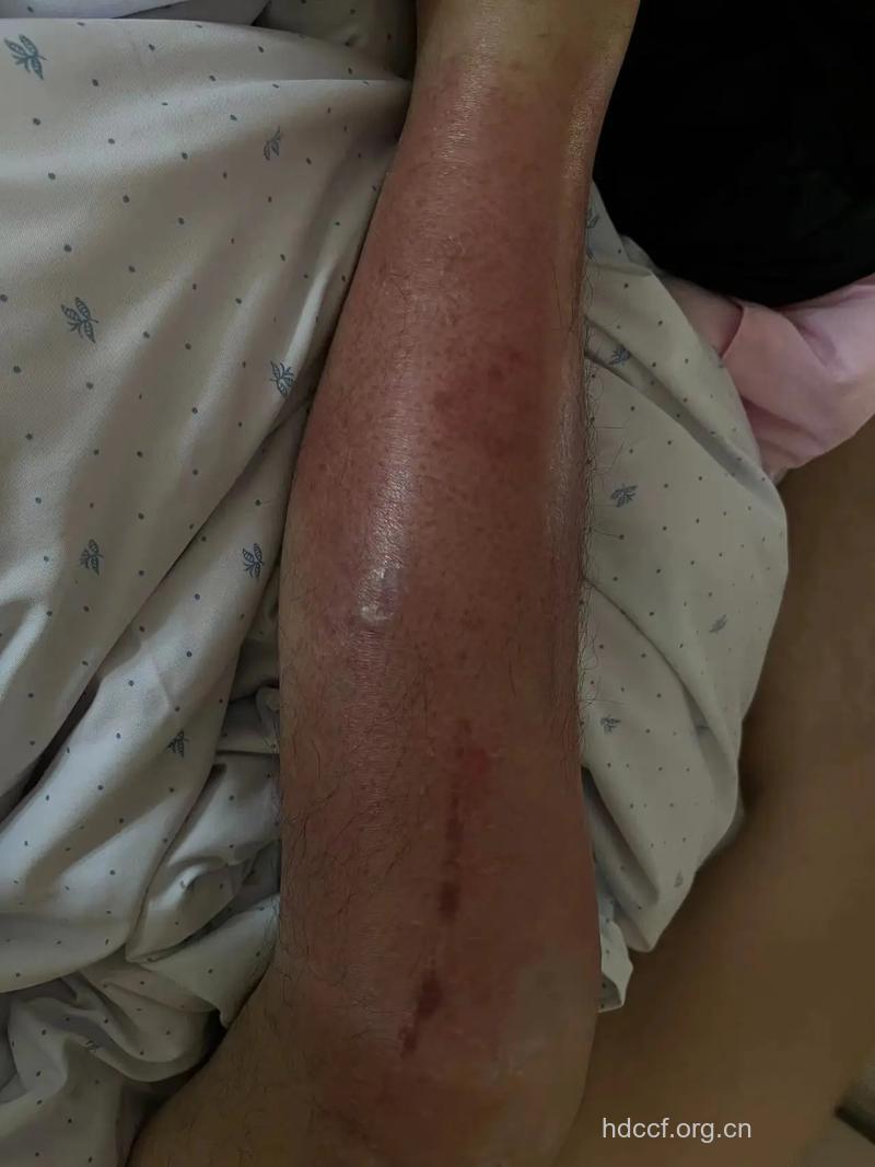 引起骨折的症状是什么