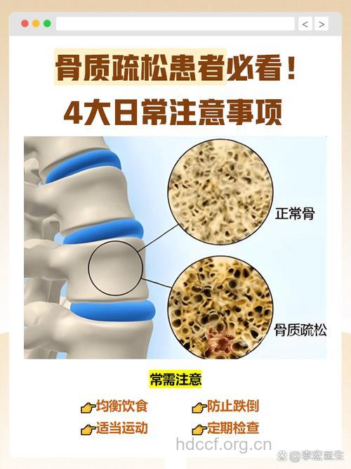 骨质疏松 糖尿病的另一宗罪