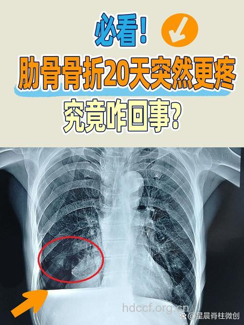 肋骨骨折的表现