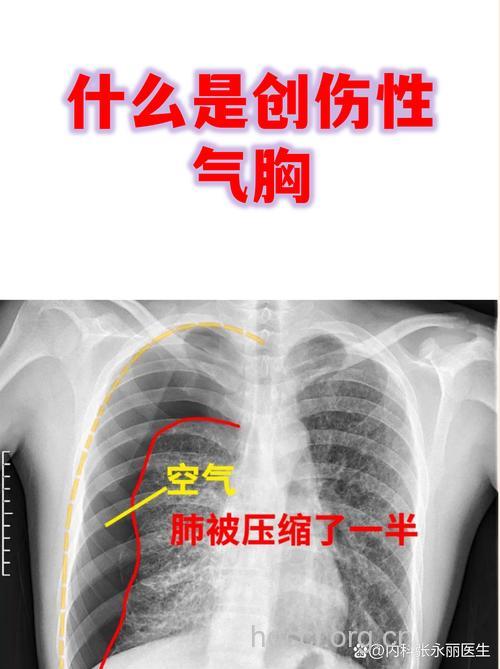 创伤性气胸 (开放性气胸)是怎么形成的？