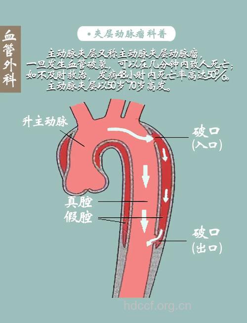 三个动脉内会发生动脉瘤的基本原因