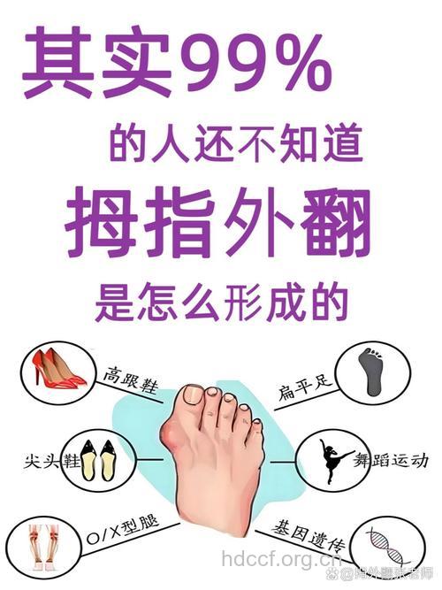 拇指外翻有哪些注意事项