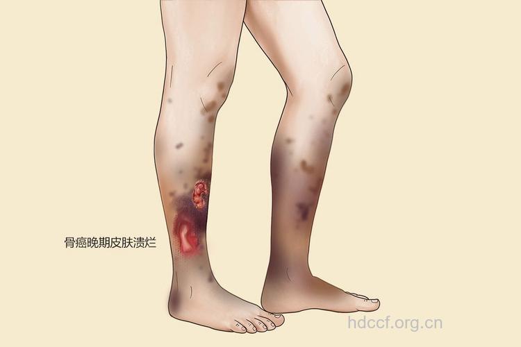 骨癌的晚期有哪些症状出现