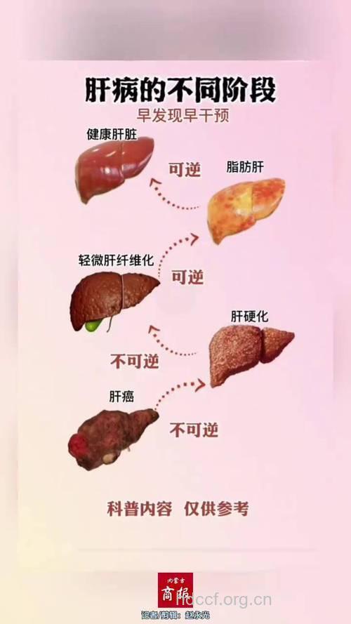 别小看脂肪肝 脂肪肝成肝癌新增长点