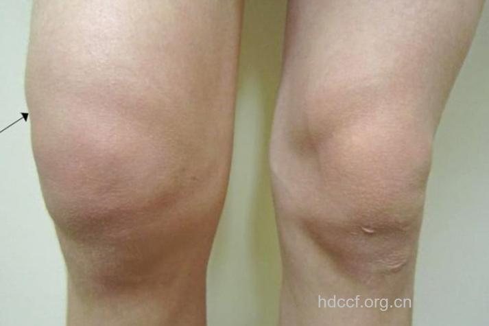 骨肿瘤的早期症状有什么