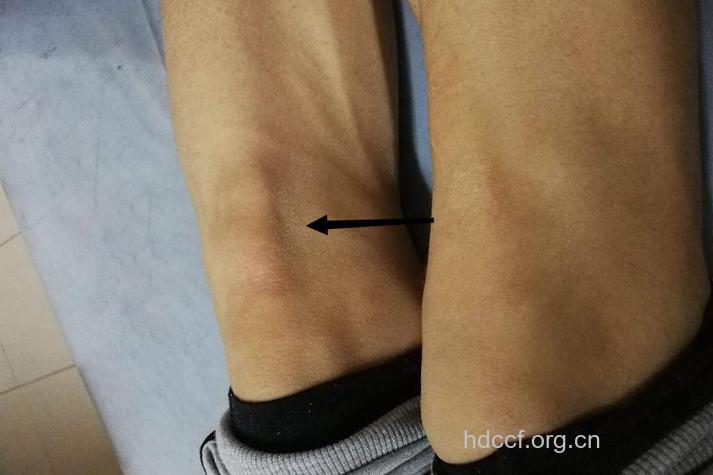 骨癌患者有什么早期症状