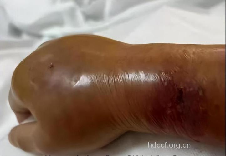 引发骨髓炎病因是手指被鱼刺扎伤