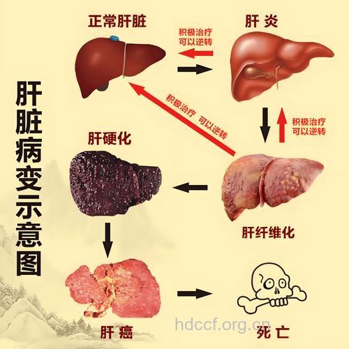 引起肝硬化的八大因素