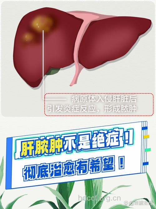 肝脓肿的病因和治疗方法