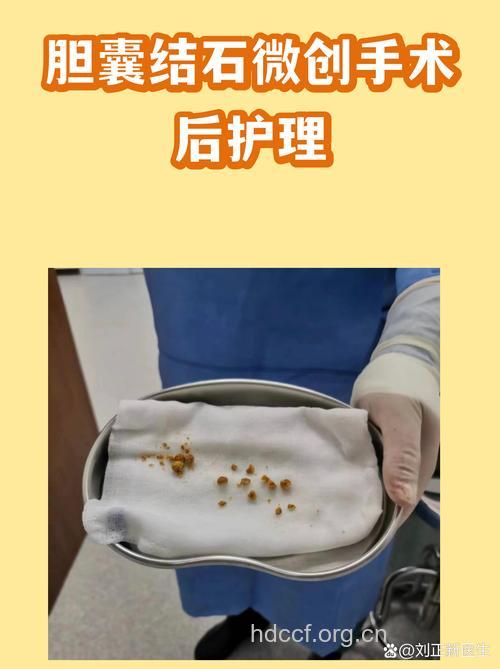 胆结石手术前后的护理方法