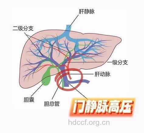 怎么治疗门脉高压晚期