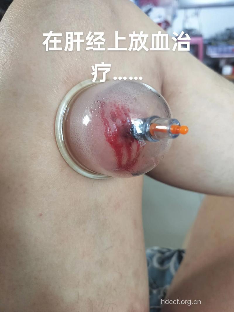 肝癌上消化道出血中医疗法