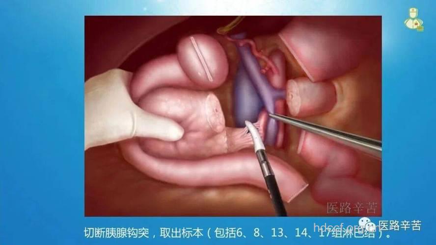 怎么手术治疗环状胰腺