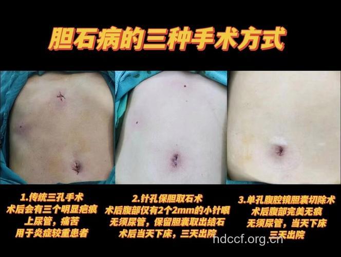哪些非手术方法可知道胆囊结石