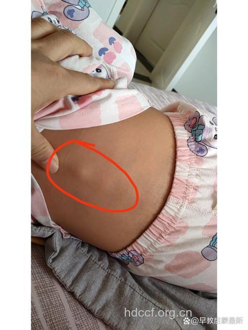 孩子太胖致腰椎间盘突出