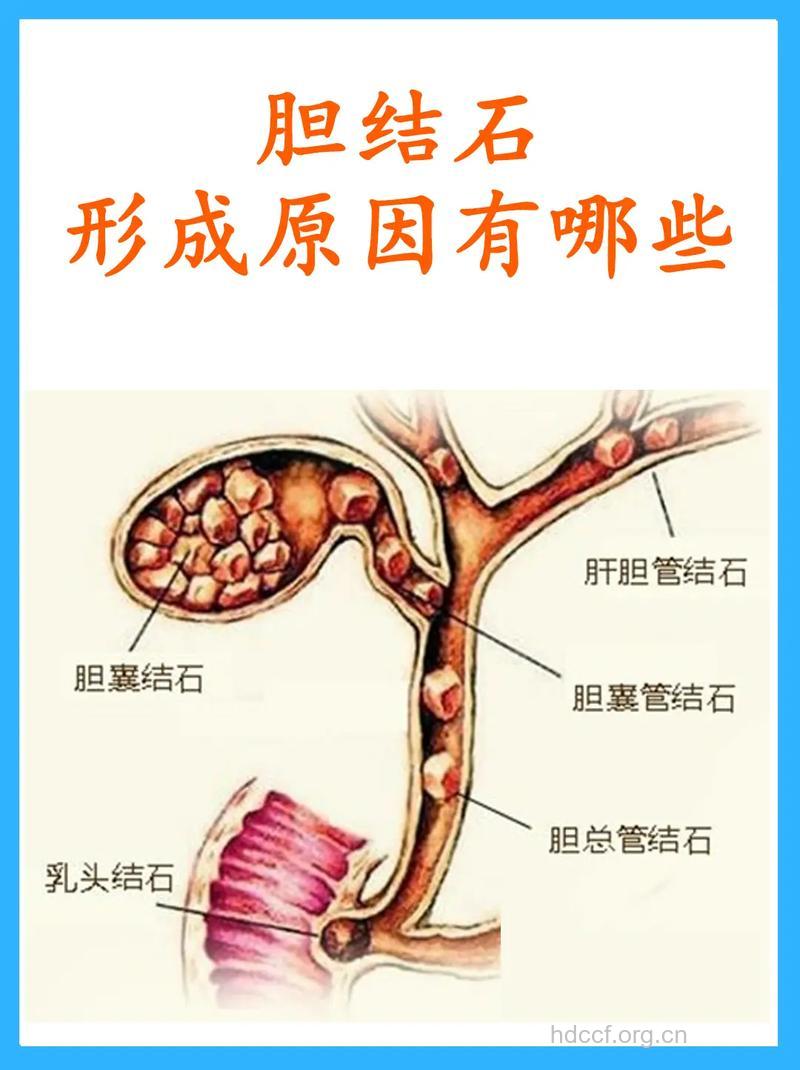 哪些原因导致女性胆结石