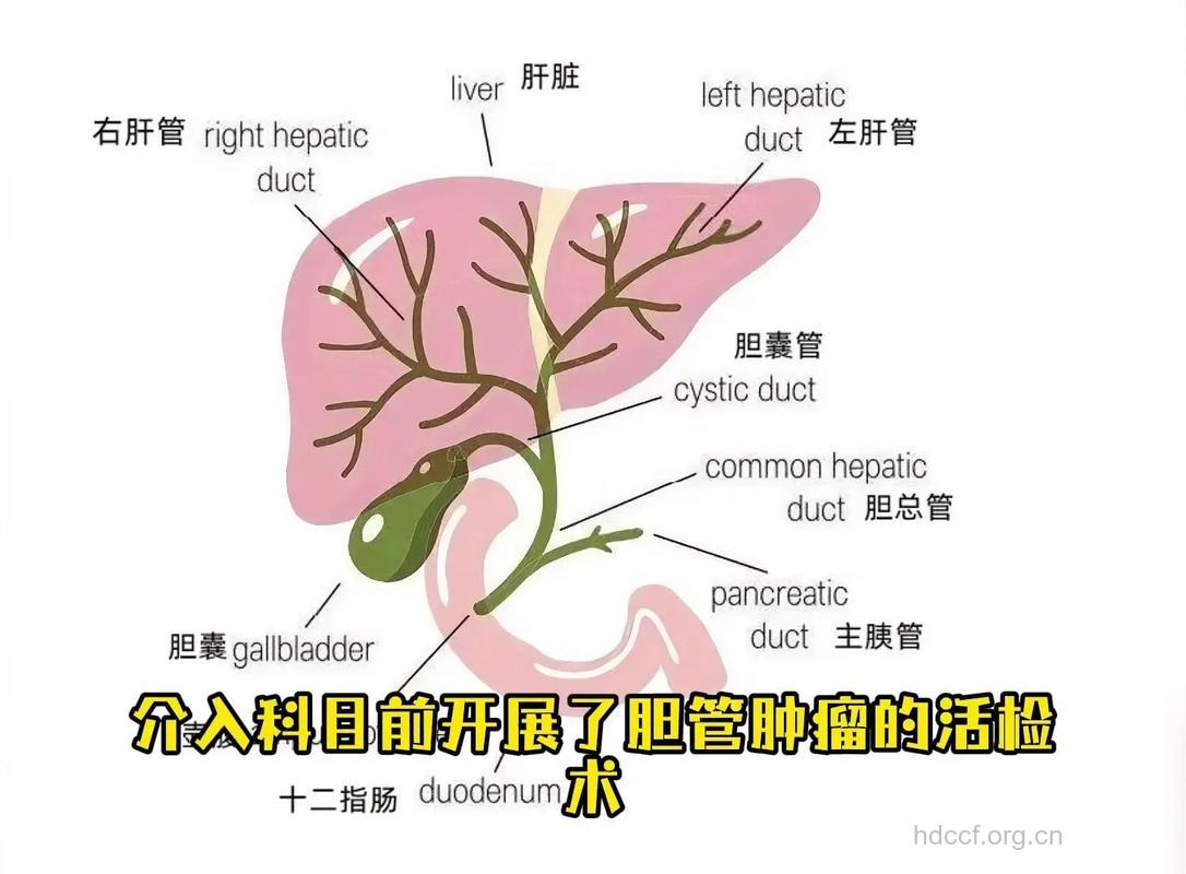 胆囊良性肿瘤发病的病理