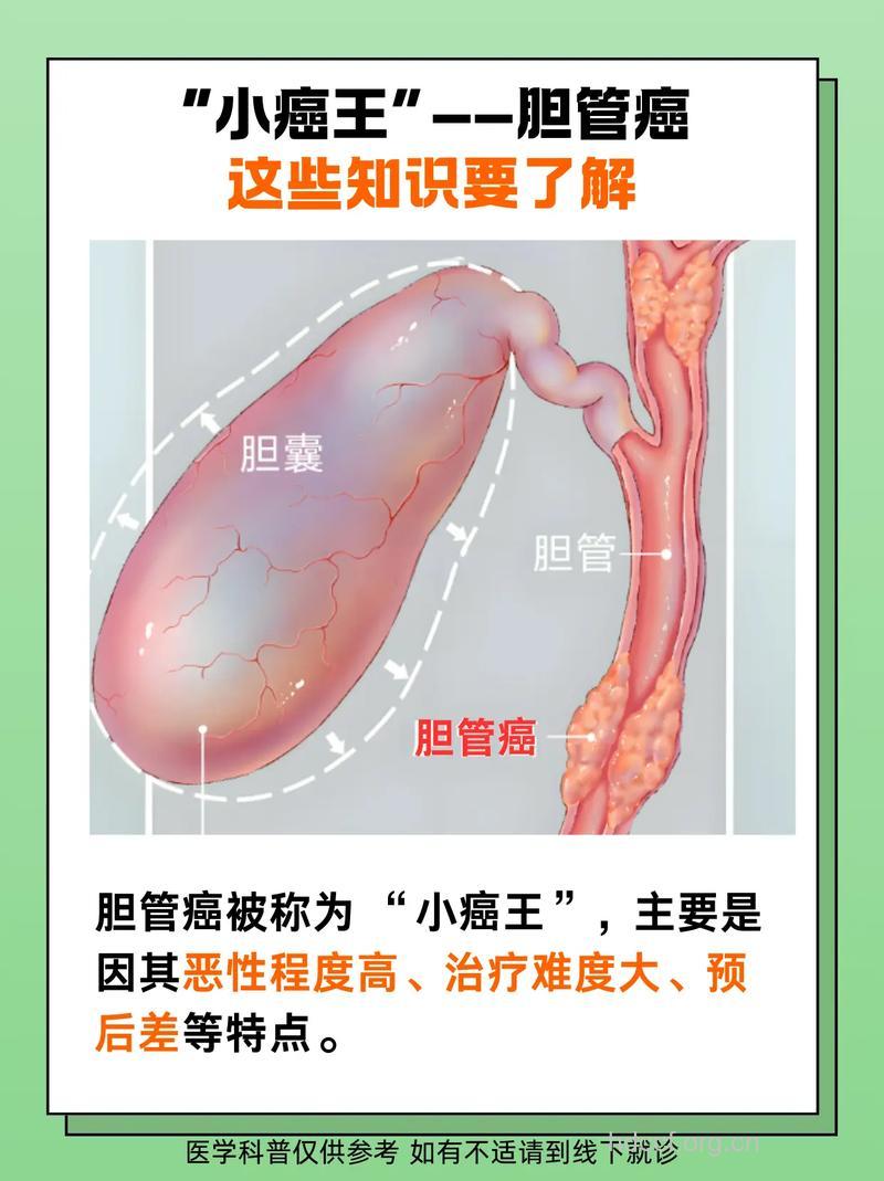 胆囊癌的鉴别方法