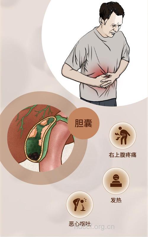 胆囊癌有哪些症状