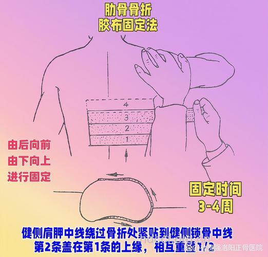 各种骨折如何固定?