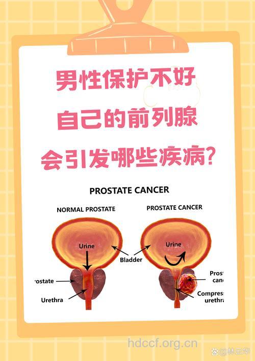前列腺男人千万别碍于面子