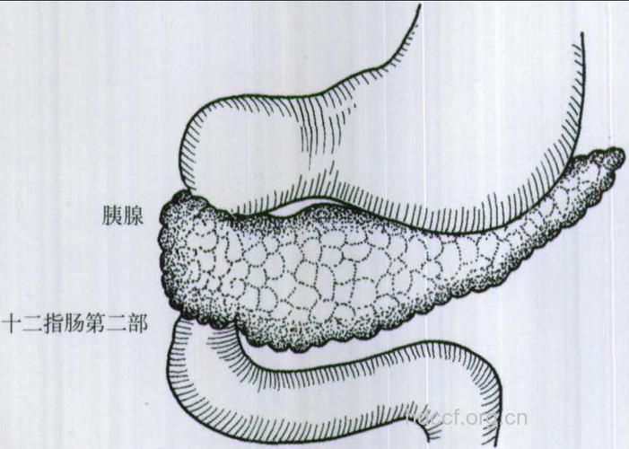 环状胰腺的处理方法