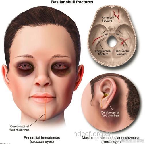 眶底骨折的临床表现