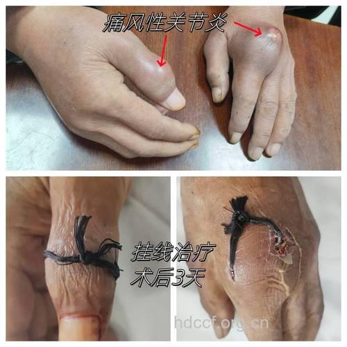 西医治疗风湿性关节炎