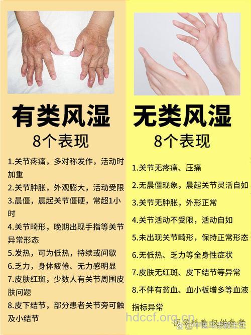 风湿病治疗误区在哪里