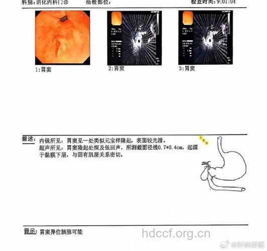 异位胰腺是如何诊断的？