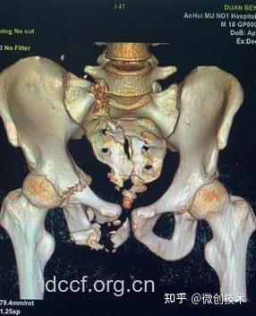 骨盆多发性骨折案例分析