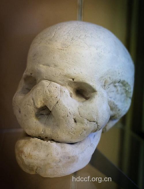 狮子脸源于脸部骨质增生